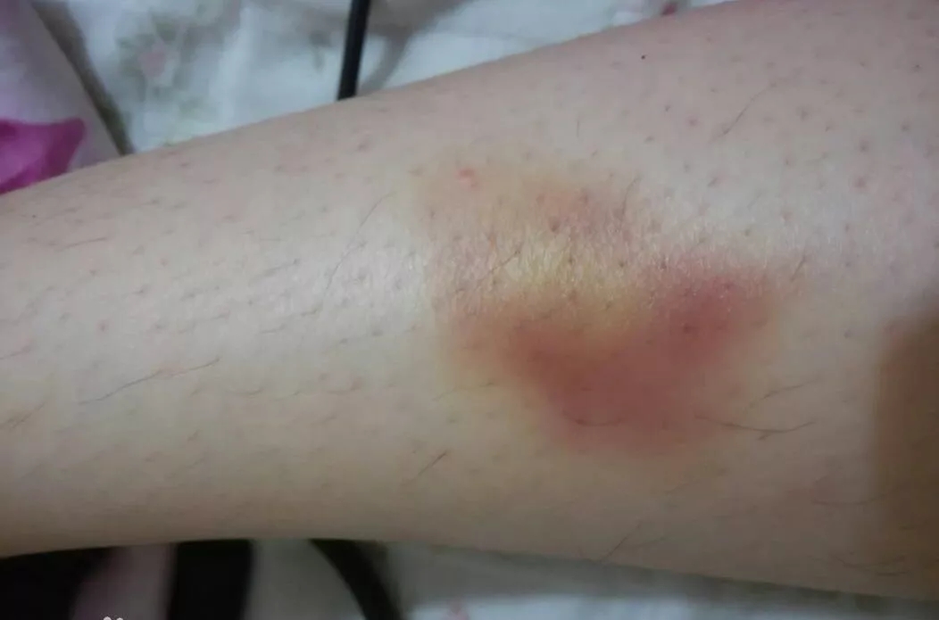 没有磕碰,皮肤出现淤青是怎么回事?