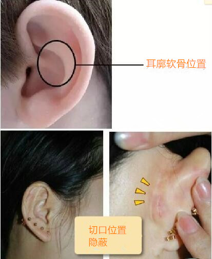 为什么要用耳软骨垫鼻尖?