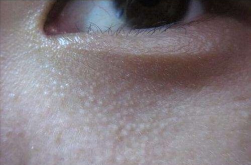还有一部分没有形成大的颗粒物时,眼睛下面的皮脂腺异位症.