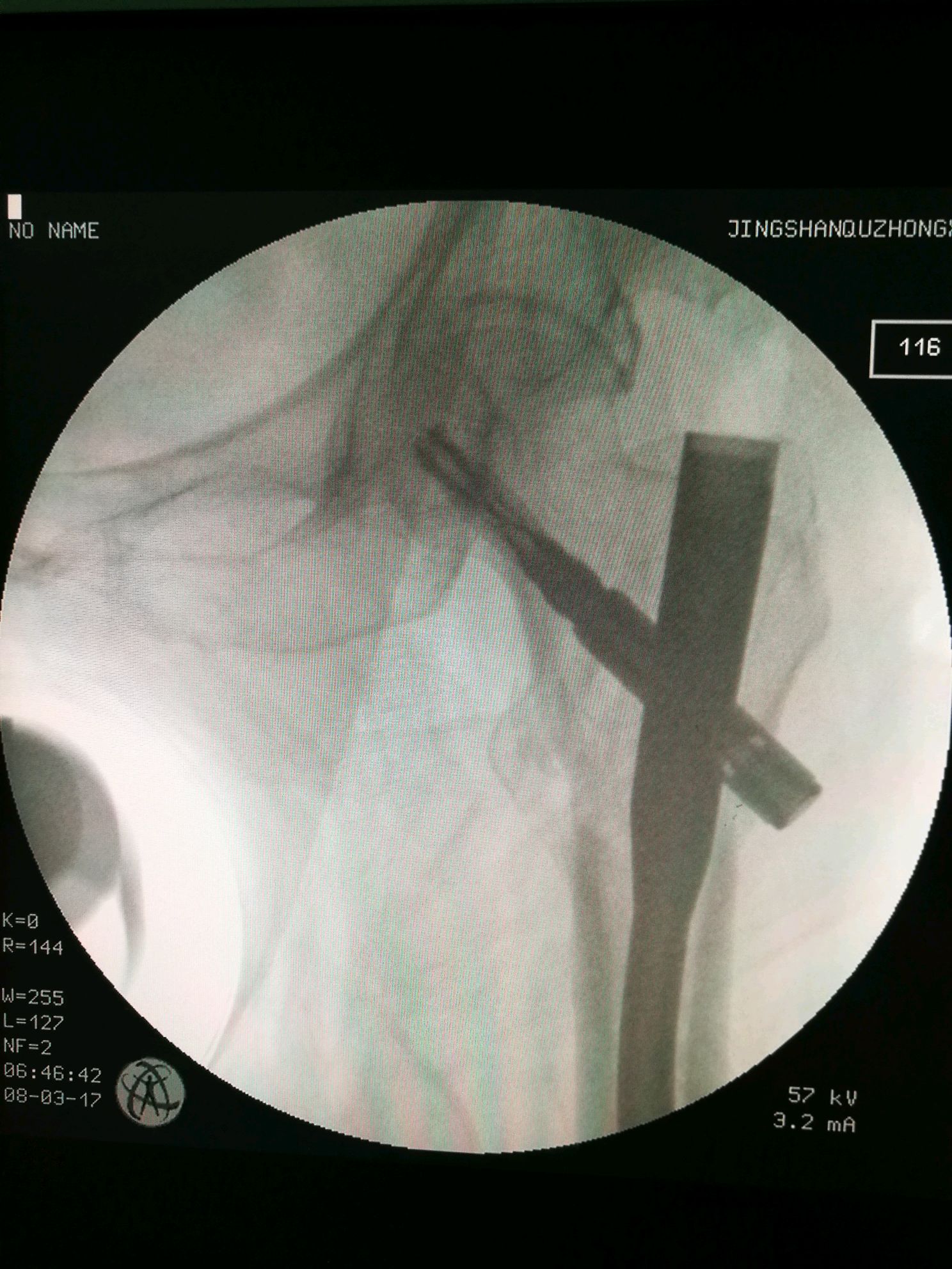 老年股骨转子下骨折