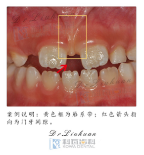 孩子換牙後,門牙牙縫為什麼特別大?