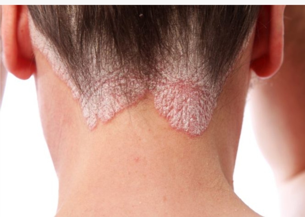 银屑病「牛皮癣」是真菌感染所致的「癣病」吗?