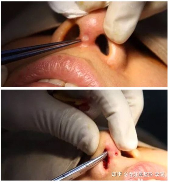 鼻部异物取出鼻修复案例合集l型鼻假体该淘汰了