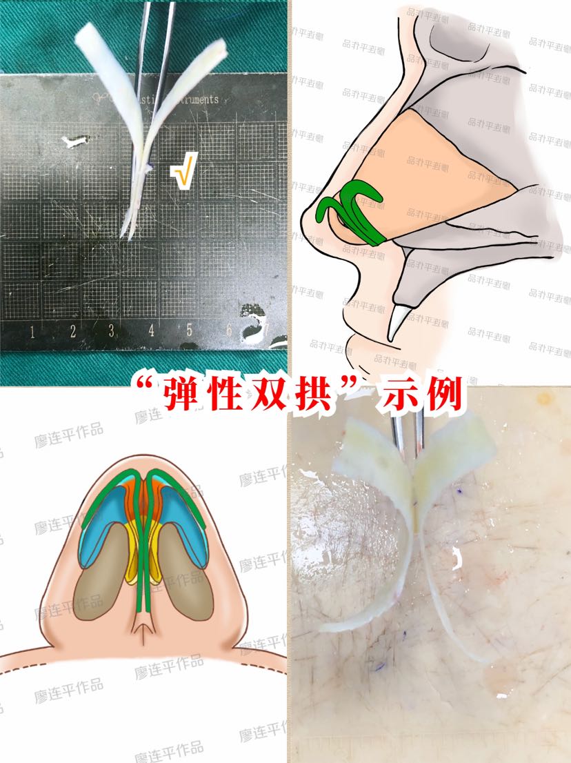 隆鼻功课篇:鼻支架最全解析!