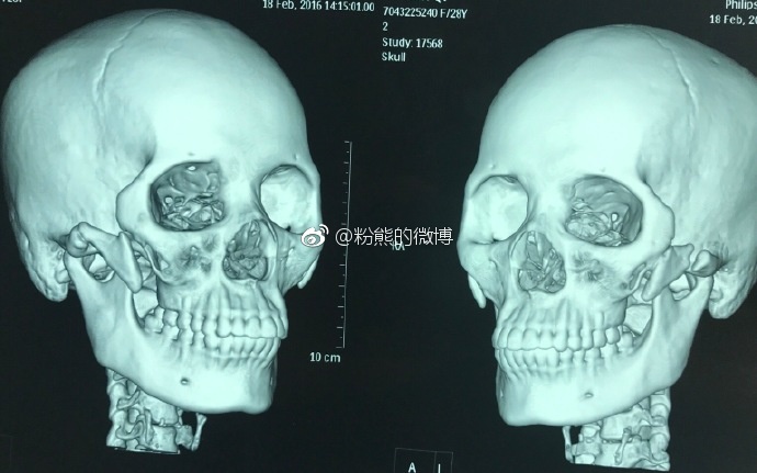 颧骨内推为什么一定要固定?骨不连有什么可怕后果?