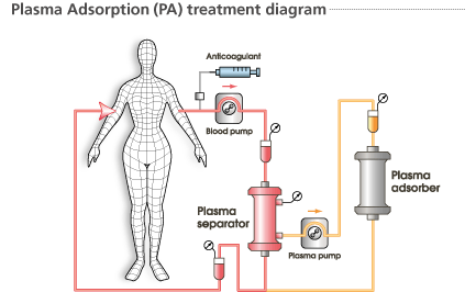 單重血漿置換:血漿分離器分離患者的血漿和血細胞,棄掉含有含有致病