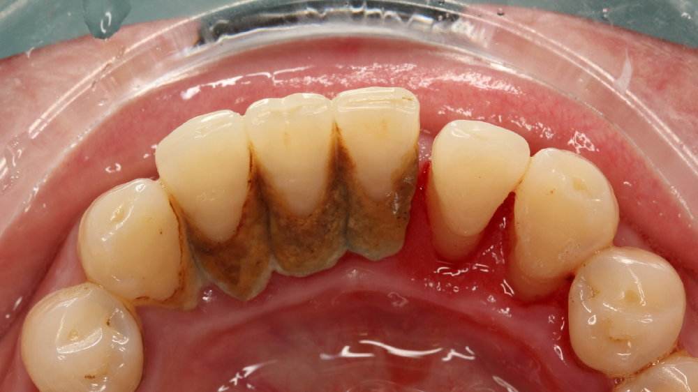 要说牙龈出血的原因,最常见的就是菌斑和牙结石.