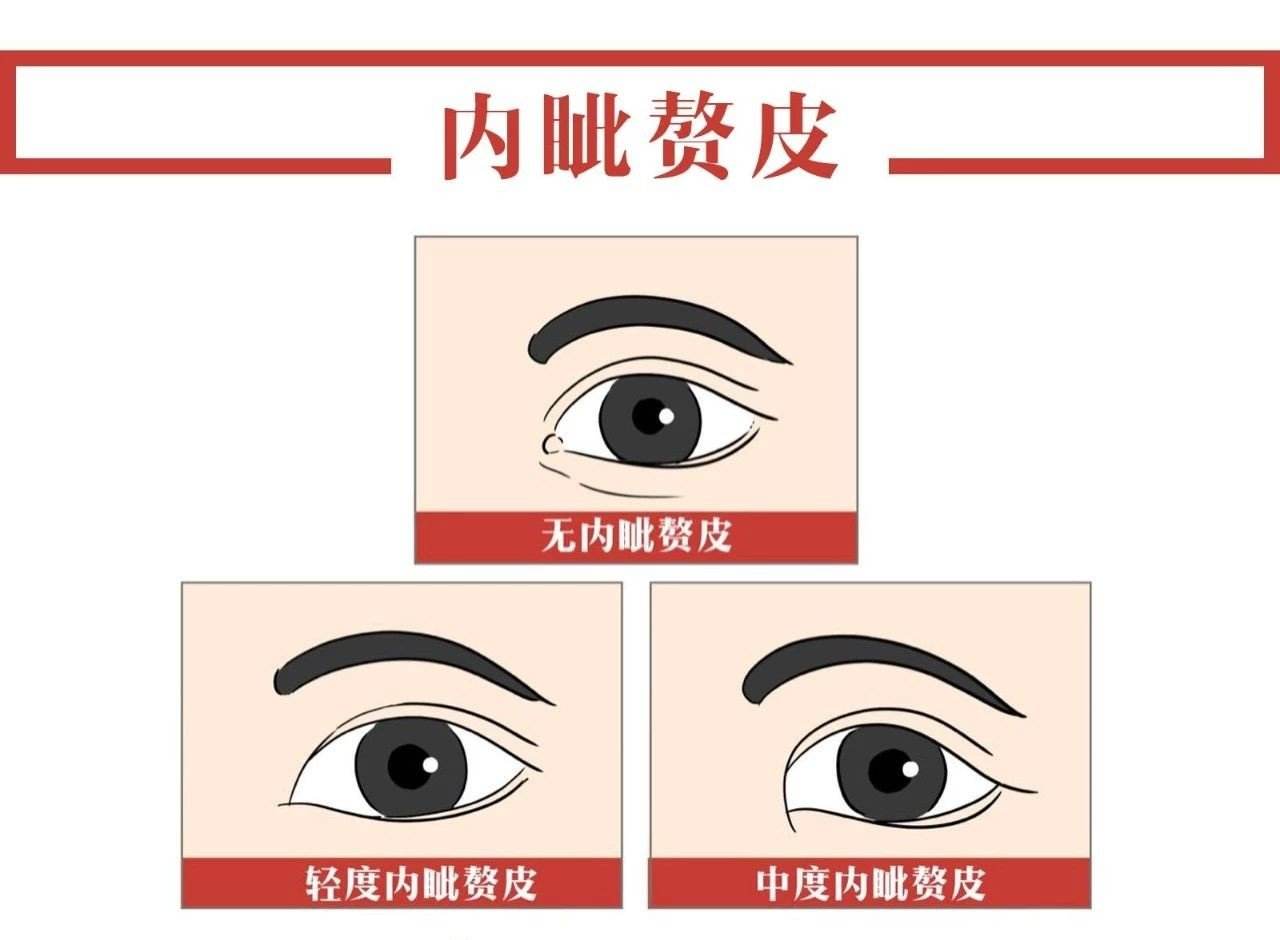 内眦赘皮是内眼角的一块垂直皮肤皱褶.