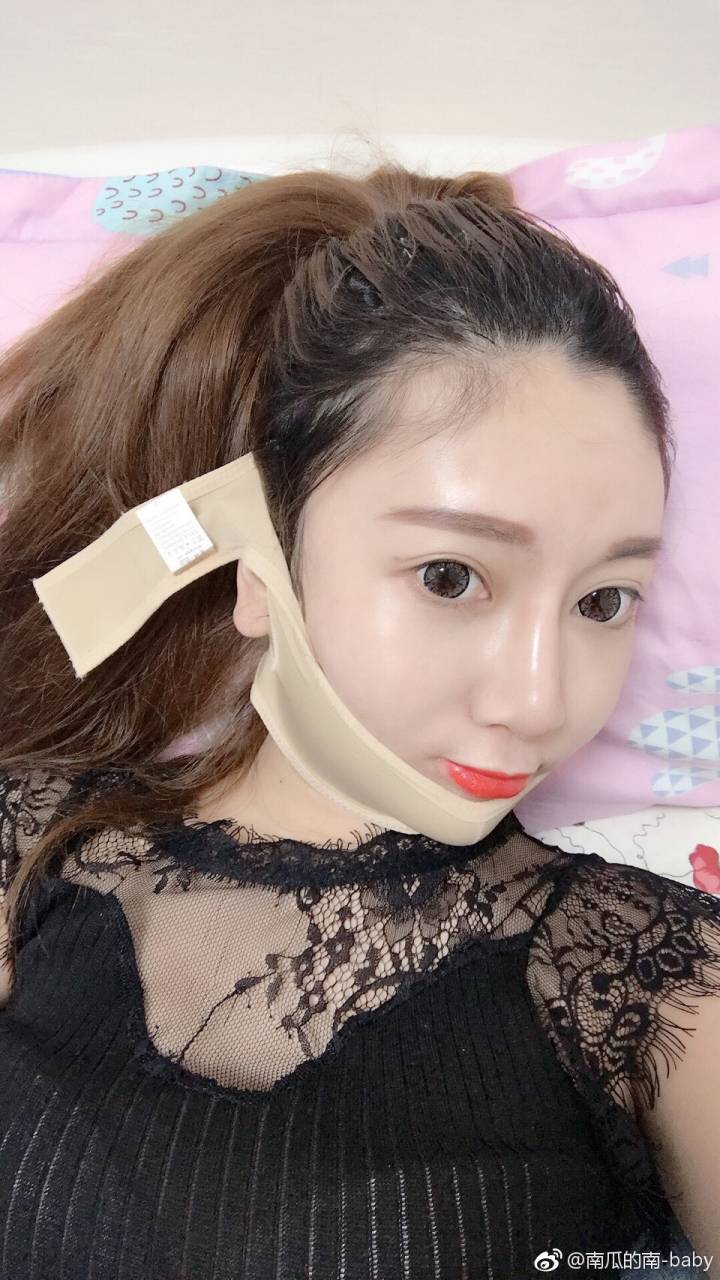 磨骨瘦脸下颌角削骨取咬肌手术第四天