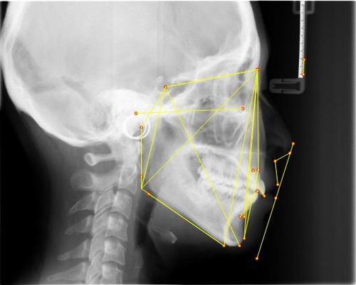 牙齿矫正前需要收集哪些资料