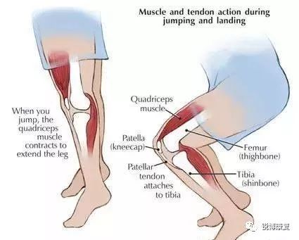 髌骨软化竟偏爱运动爱好者