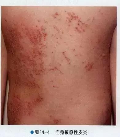 13)隐翅虫皮炎:是由于皮肤接触隐翅虫毒液所引起的急性炎症反应.