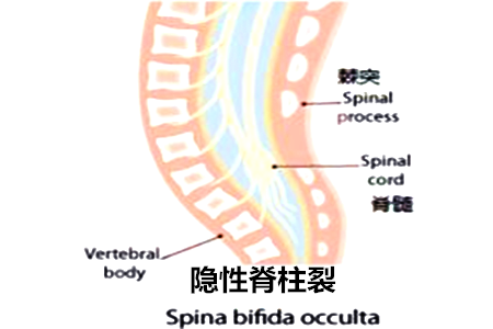 脊柱裂患者都需要手术no这些时候才需要