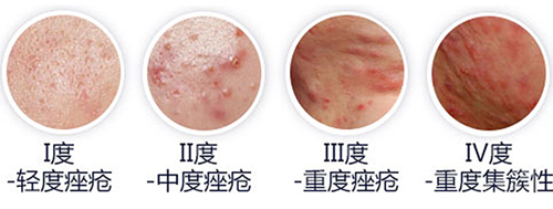 痤疮有哪些类型?