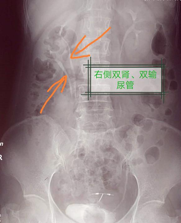 她腰部胀痛,尿频,尿痛2年,原来是"第三个肾脏"在作怪!