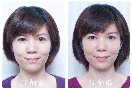 放松颏肌对下巴后缩有一定的改善效果,更好是配合玻尿酸或假体隆下巴