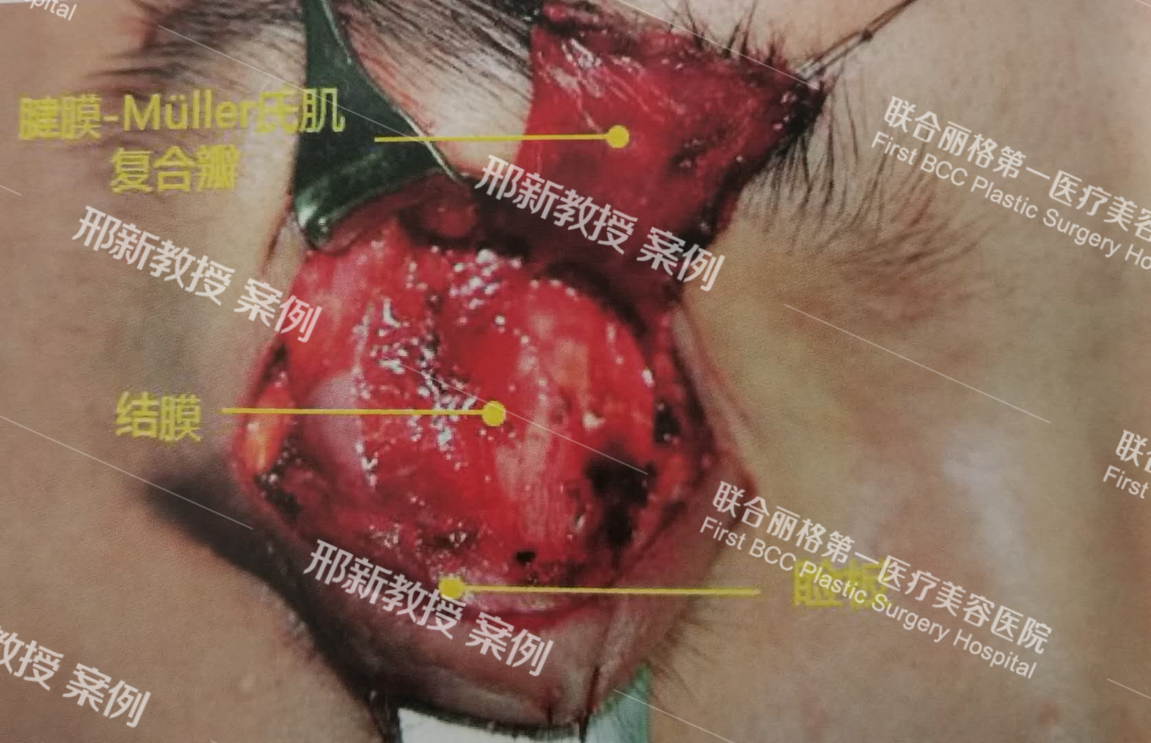 上瞼提肌腱膜推進法上臉下垂矯正術及案例