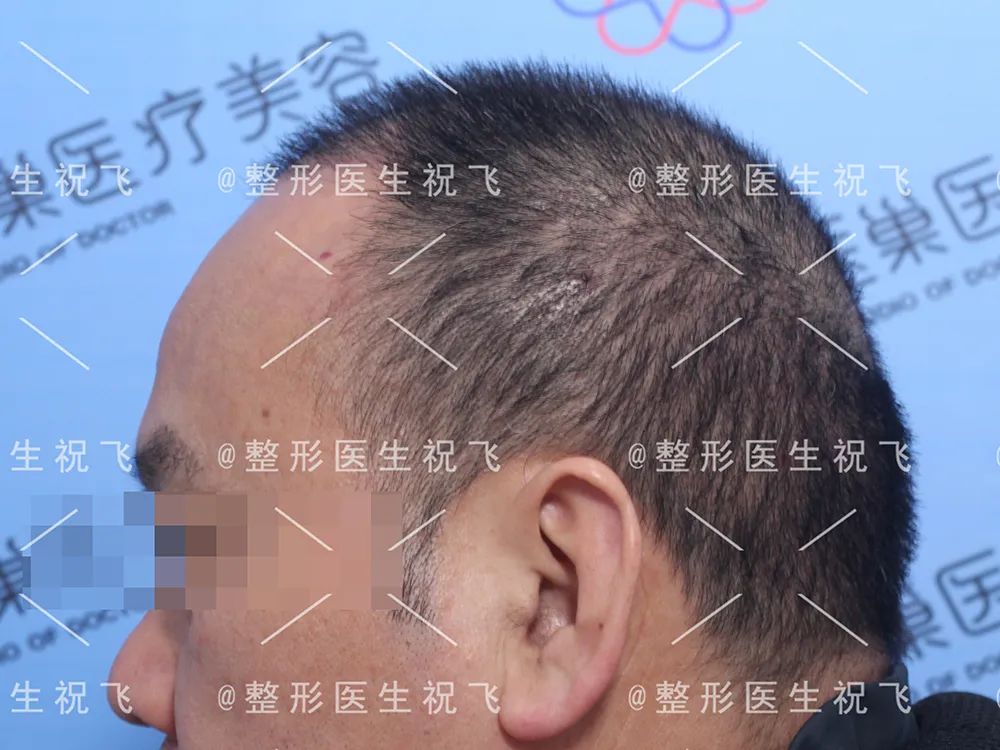 植发案例丨fue种植发际线 头顶加密
