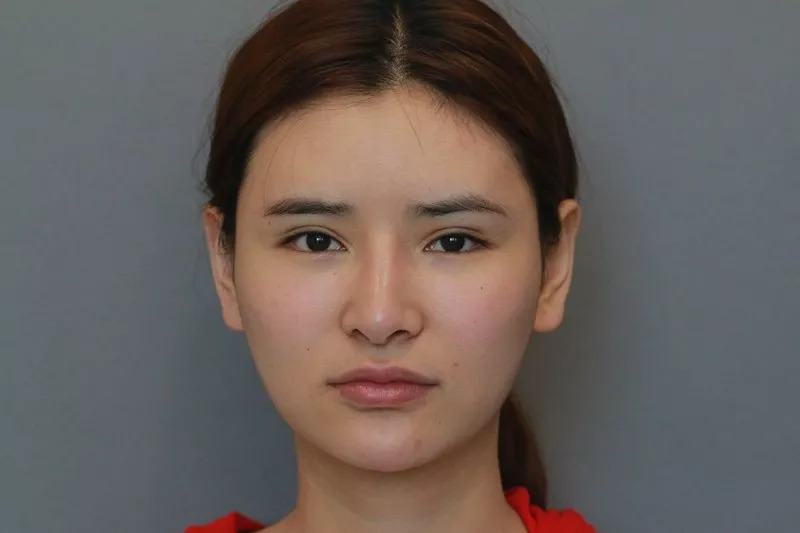 鼻背骨歪了怎么办