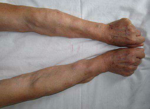 脂肪瘤需要手术切除吗?