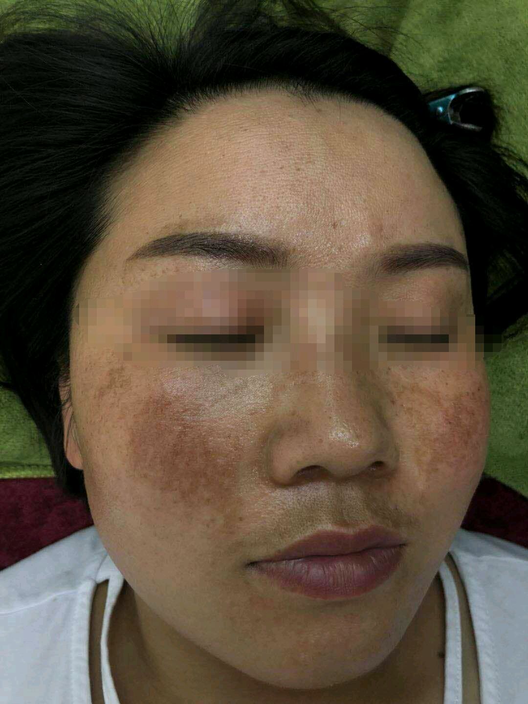 【醫學美容】40歲男子激光美容後 面部嚴重燒傷毁容求助 | Health Concept | LINE TODAY