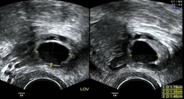 卵泡长得好不好？了解卵泡监测的那些事就知道了