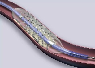 颈动脉堵了52%,应该吃药还是手术?一次性讲明白