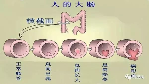 多數大腸腺瘤性息肉起病隱匿,無任何臨床症狀,少數表現為大便習慣改變