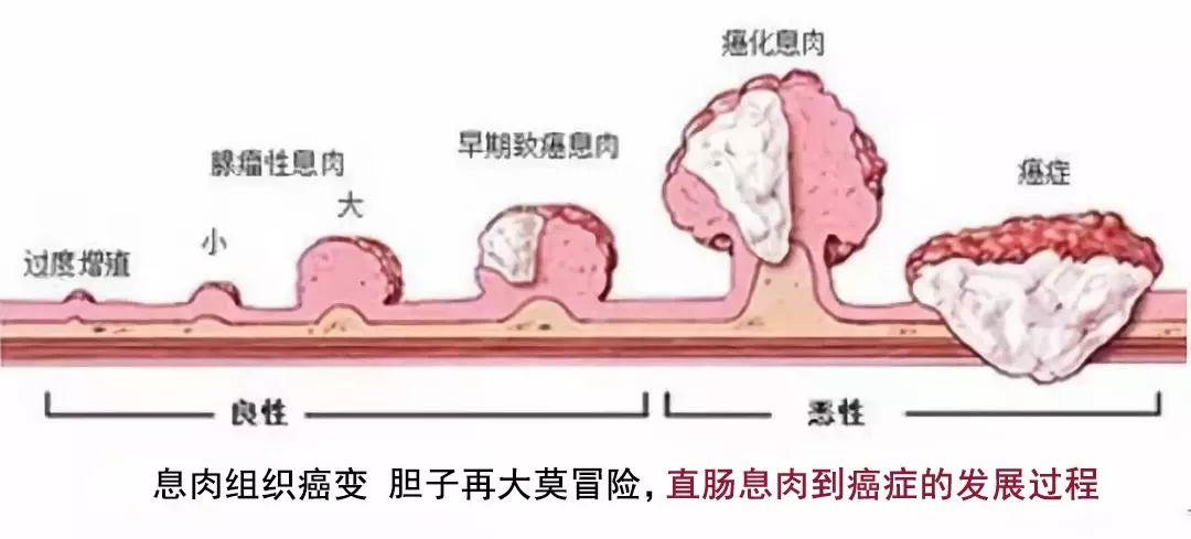 無論鼻息肉胃息肉腸息肉息肉都有自己的表白