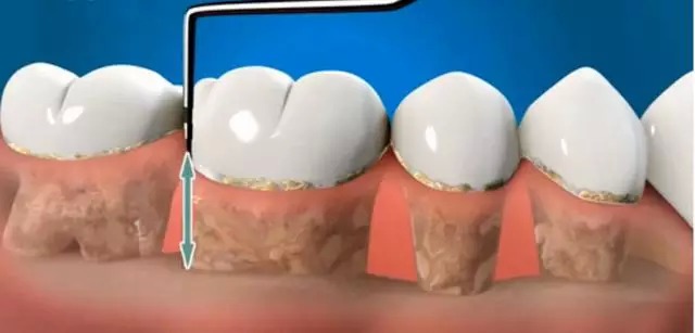 深度图解:牙周治疗—龈下刮治术