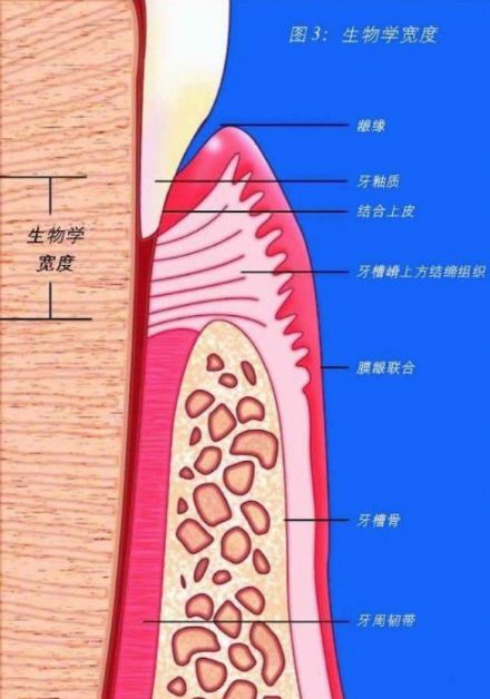 04mm,不可进入距离龈沟底0.