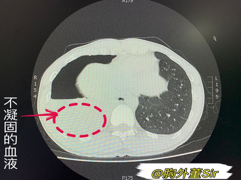 血胸胸片典型图片图片