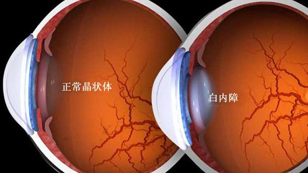得了青光眼还能抽烟吗