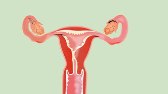 宫腔粘连对胎儿会有什么影响