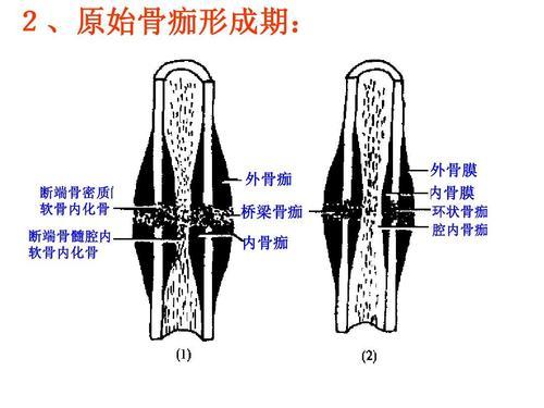 骨折导致,骨膜下和周围组织血管破裂出血,在骨折断端及其周围形成血肿