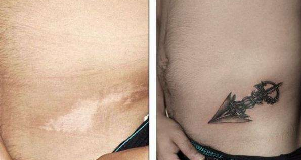 用纹身遮盖白癜风方法可行吗?