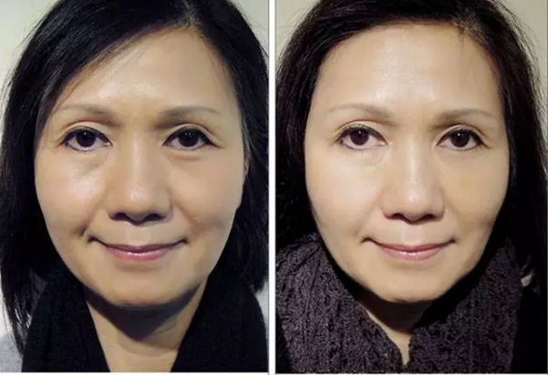 整形科普泪痕沟的形成原因及解决方法