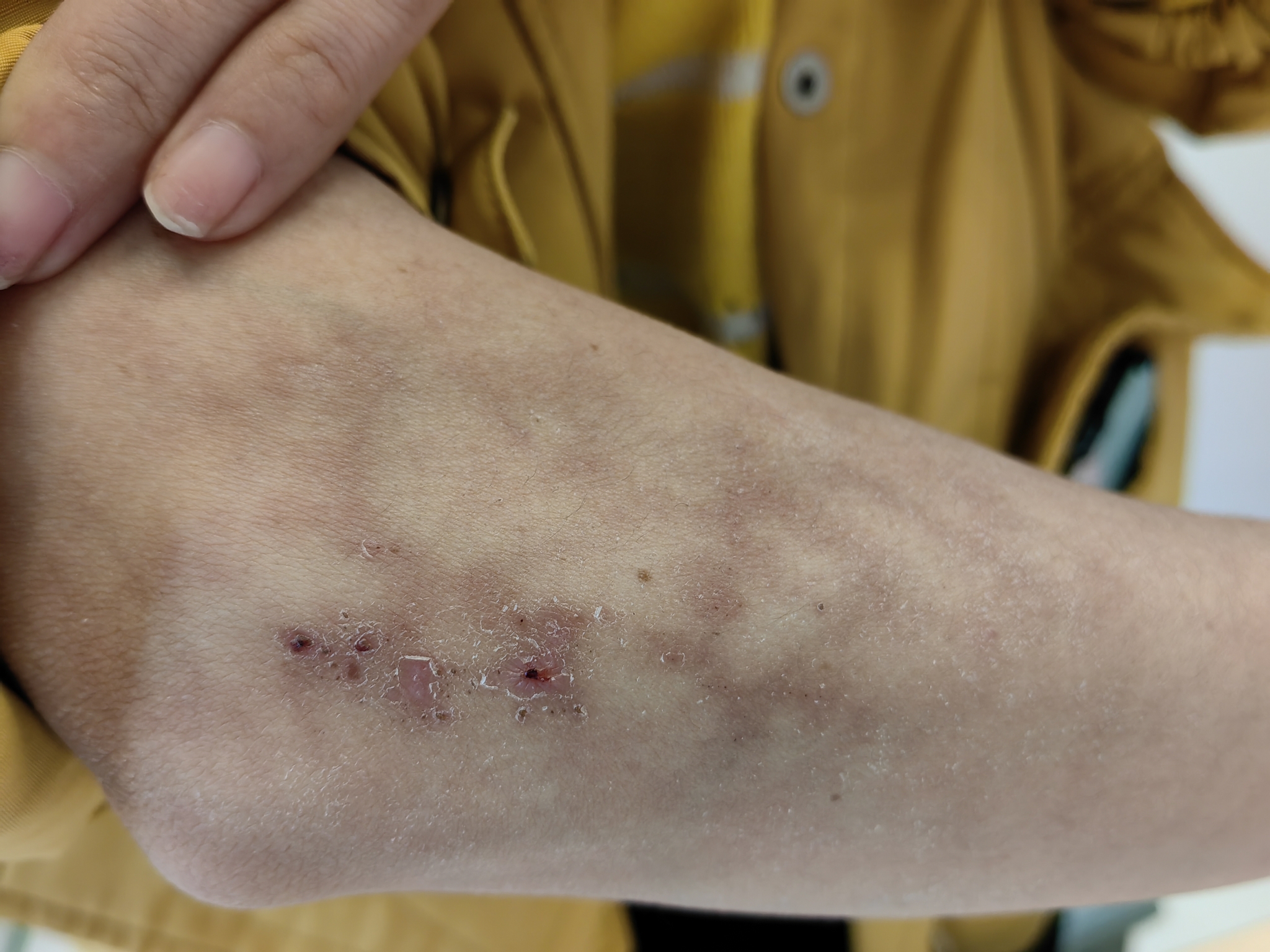 身上突现花纹水疱,真实原因让人太意外!_朱敏刚_主任医师_爱问健康