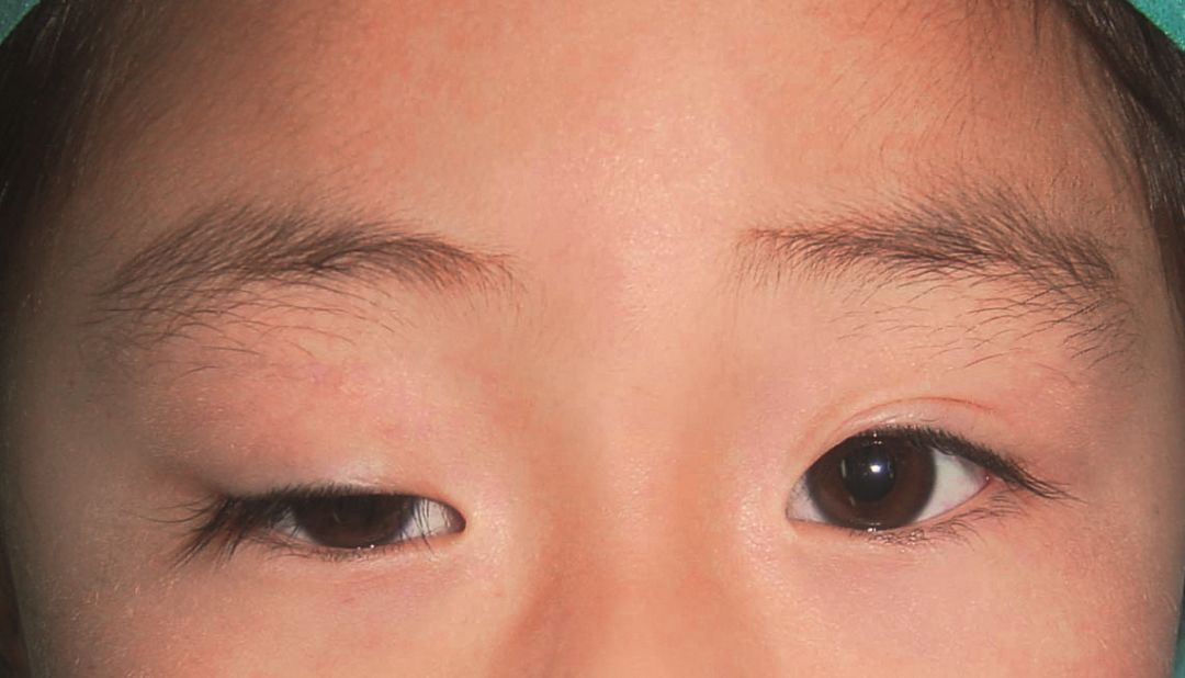婴儿眼睑下垂图图片