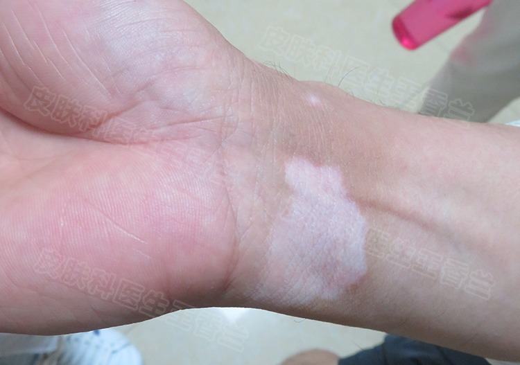 白斑とは何ですか？