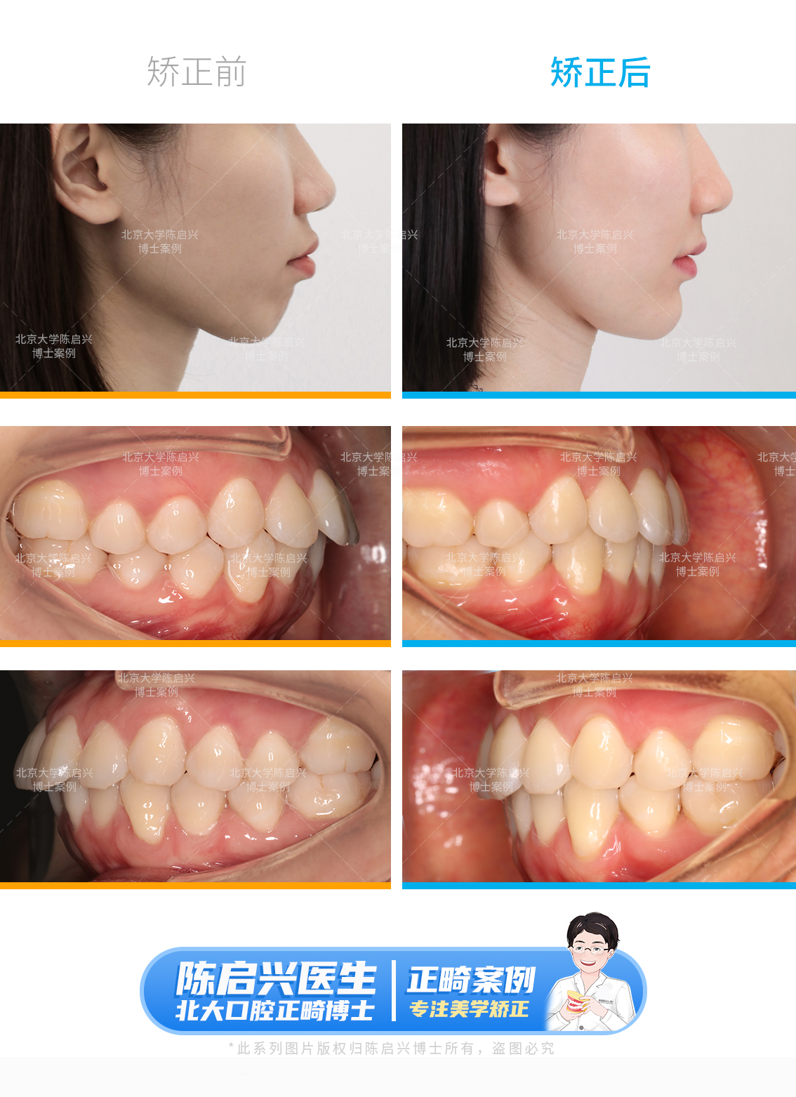 16岁男孩不拔牙解决个别牙反颌问题 - 贝致案例库 - 贝致——专业口腔服务平台，权威医生，真实案例，一次看够
