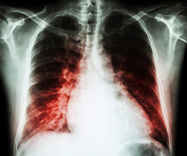 心脏一旦出现衰竭,被有人称之为心脏病中的癌症,吃什么利于康复