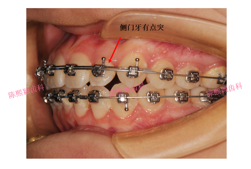 金属自锁托槽&陶瓷自锁托槽 哪个好?