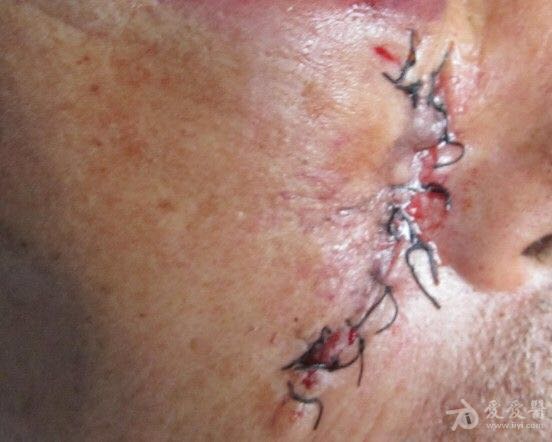 脸上摔破了,医生为什么不给你用可吸收线?