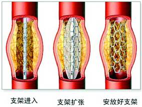 小知识心脏手术支架搭桥如何定