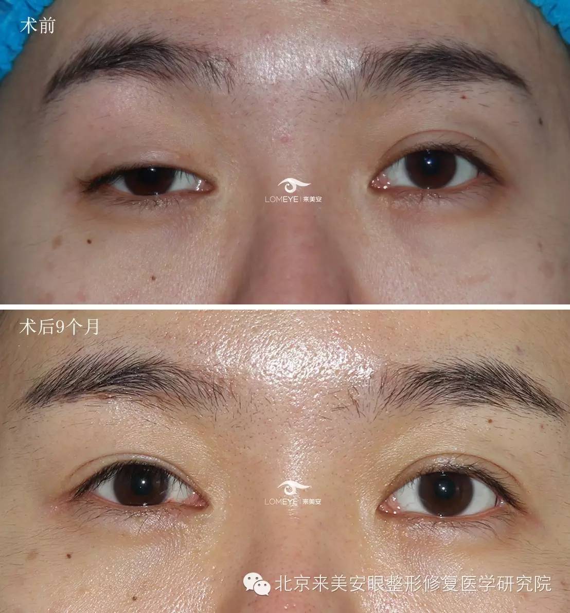 【外伤致单侧动眼神经麻痹性上睑下垂案例】cfs矫治术后9个月恢复过程
