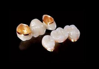 烤瓷牙兼有铸造金属全冠机械强度好和全瓷冠美观的优点,是一种较理想