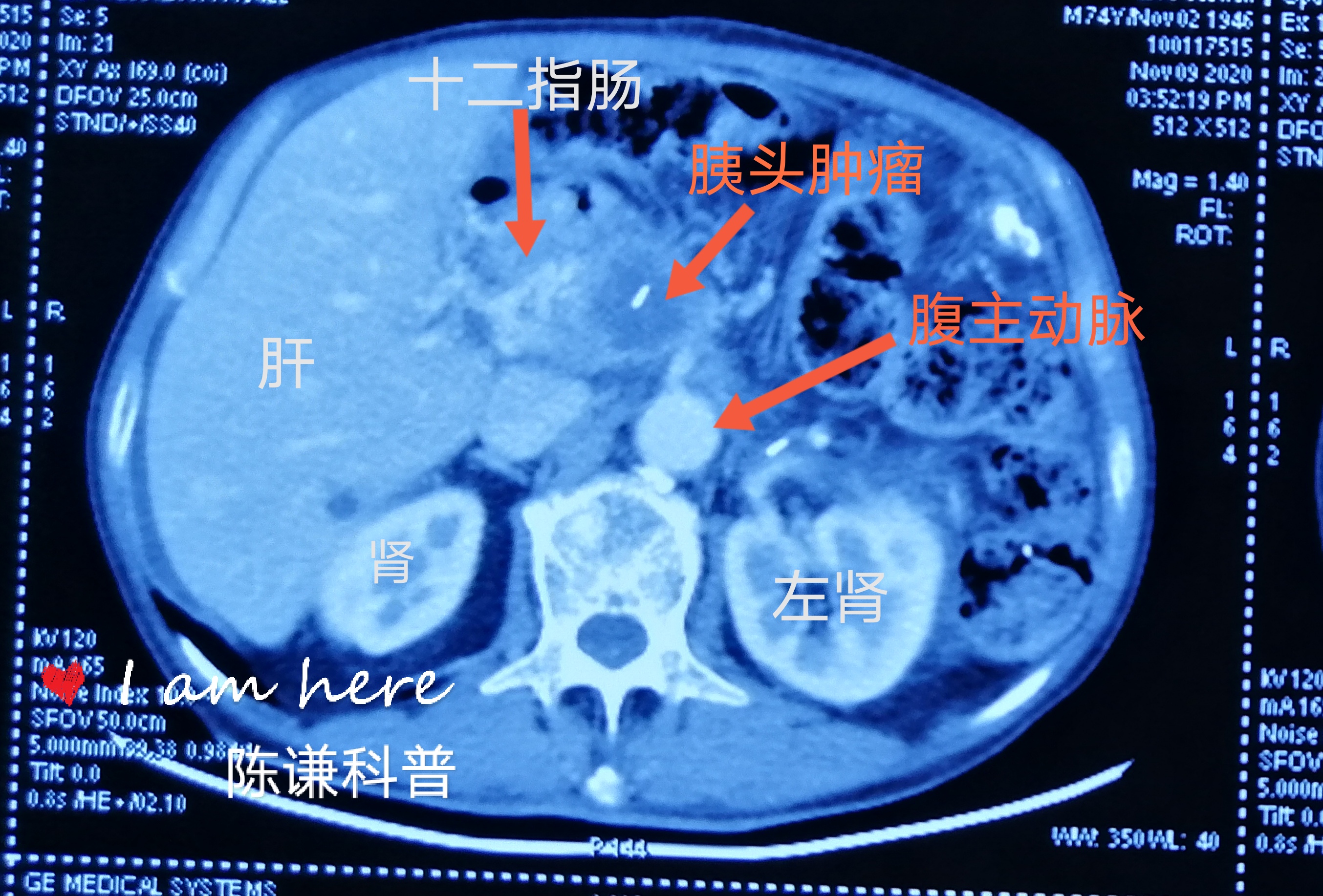 胰腺癌术后复发诊治病例分享