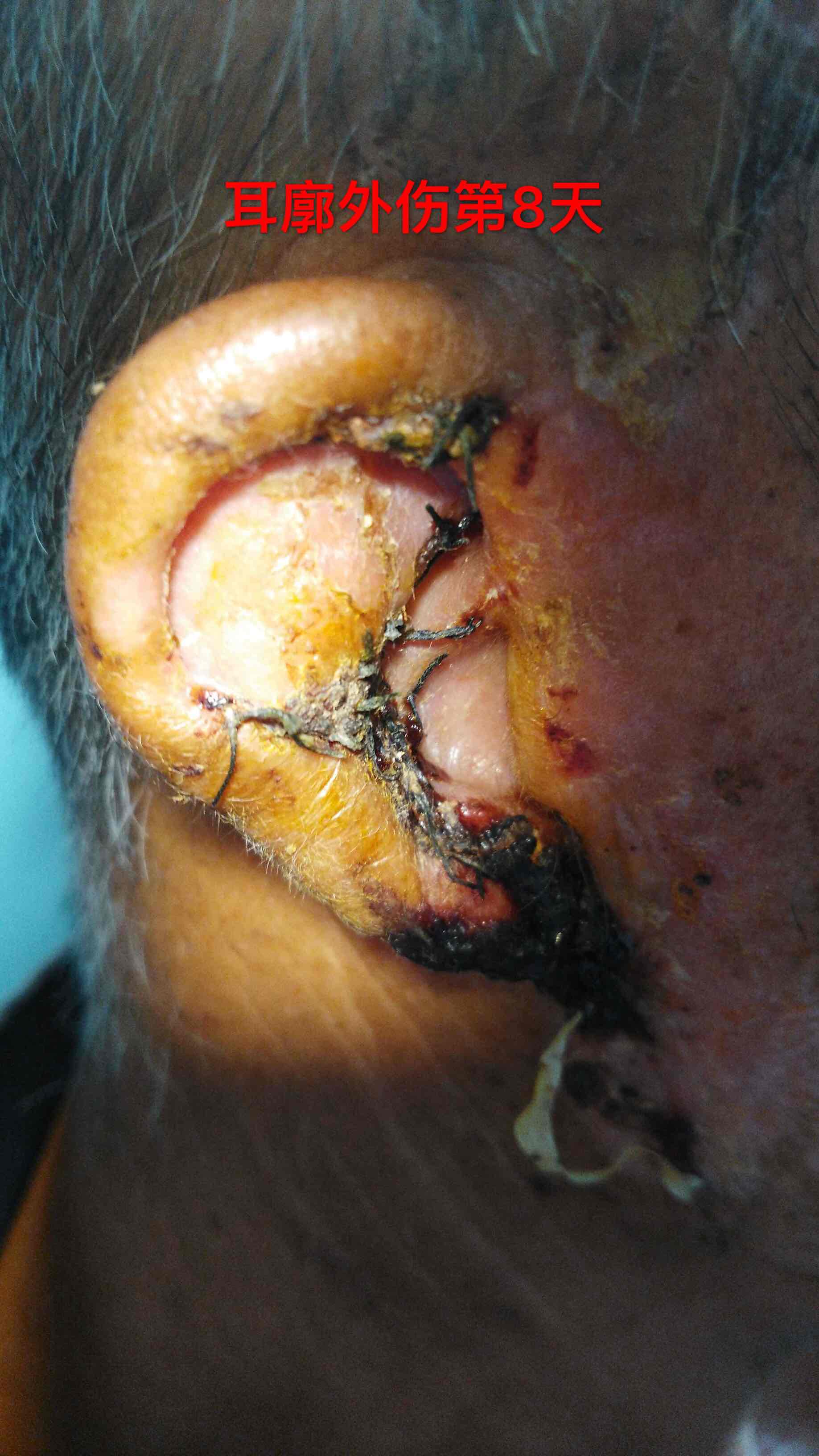 耳廓外伤的大爷经过急诊清创缝合后期精心换药最终康愈出院