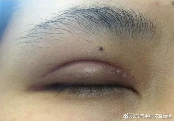 双眼皮术后出现"肉条"怎么办